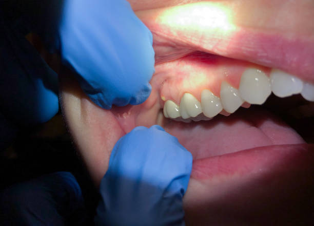 Best Emergency Gum Treatment in Tecumseh, OK